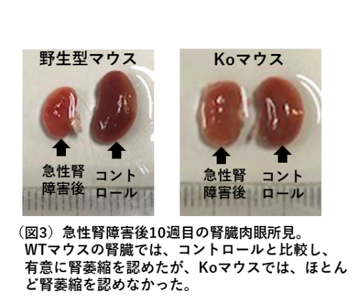 急性腎障害(AKI)から慢性腎臓病(CKD)への移行抑制